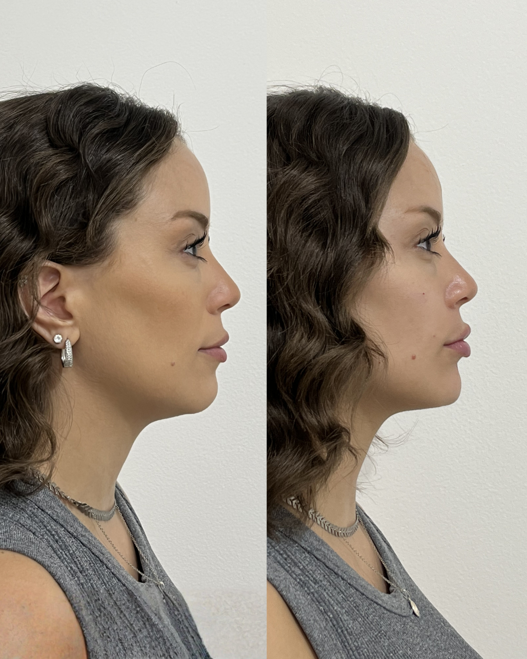 Antes e Depois — Dra. Amanda Fernandes