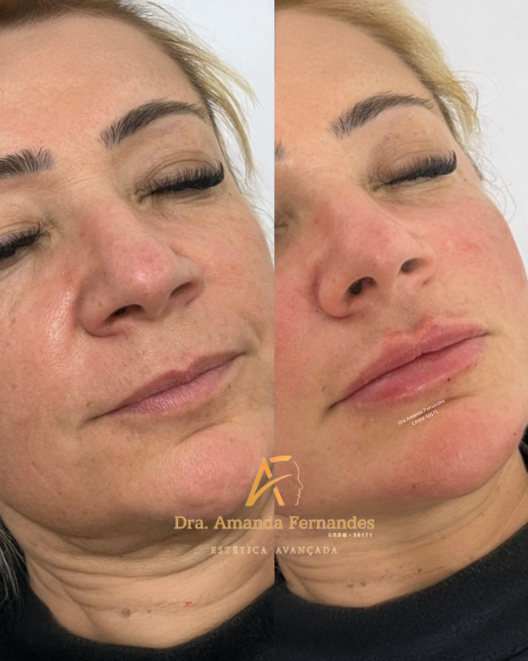 Antes e Depois — Dra. Amanda Fernandes