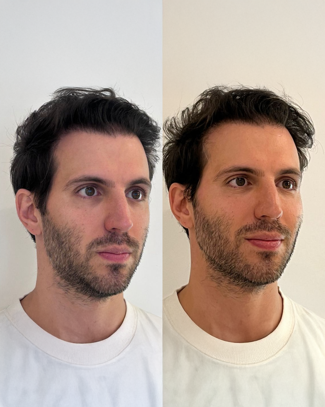 Antes e Depois — Dra. Amanda Fernandes