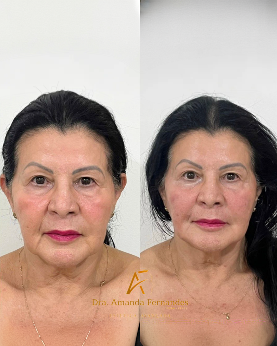 Antes e Depois — Dra. Amanda Fernandes