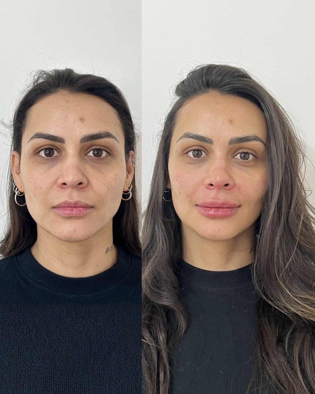 Antes e Depois — Dra. Amanda Fernandes