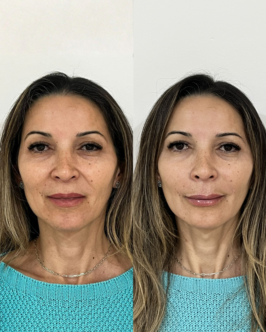 Antes e Depois — Dra. Amanda Fernandes