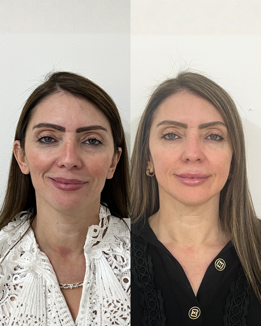 Antes e Depois — Dra. Amanda Fernandes